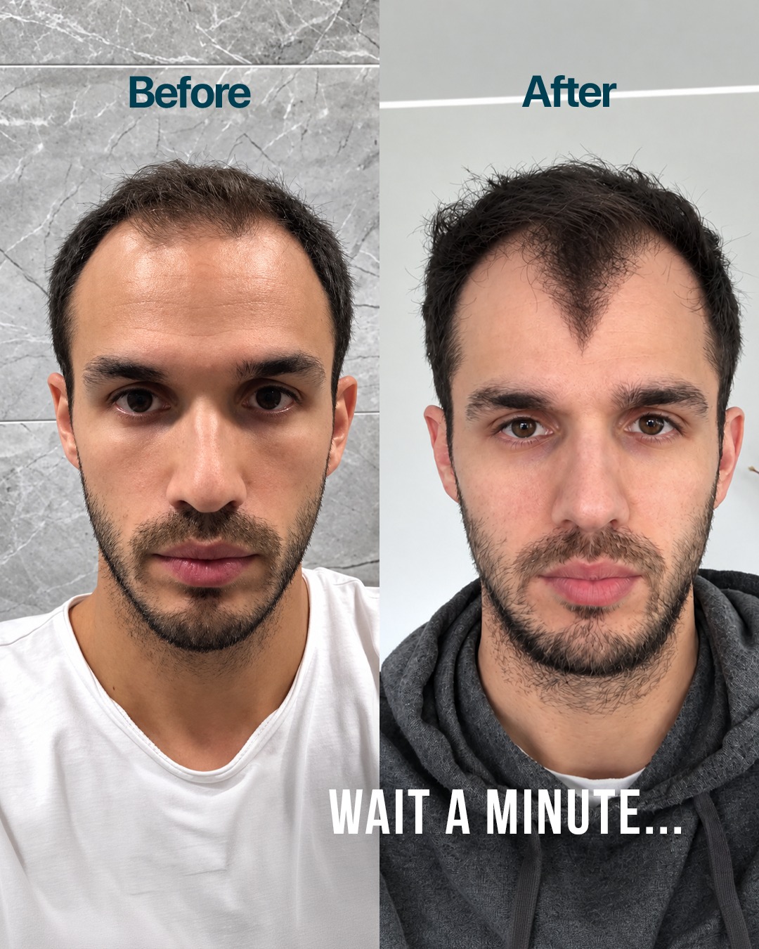 Hermest Hair Clinic | Hair Transplant Turkey Istanbul fotoğraf 6