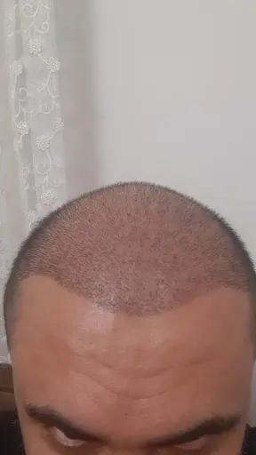 Erzurum Saç Ekim Merkezi Saç PRP`si | Altınsoy Hair Clinic fotoğraf 1