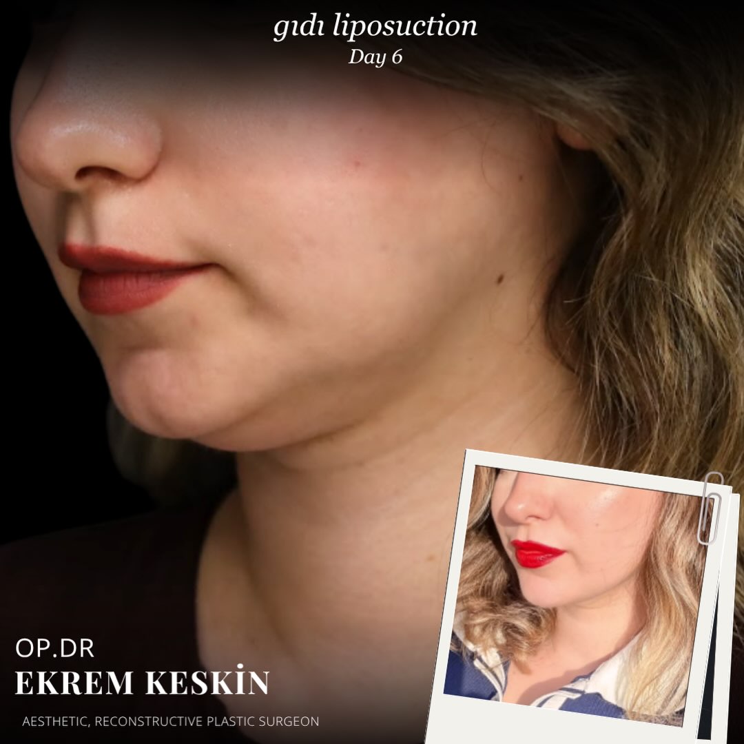 Burun Estetiği- Liposuction- Meme Estetiği-Karın germe -Op.Dr Ekrem KESKİN fotoğraf 5
