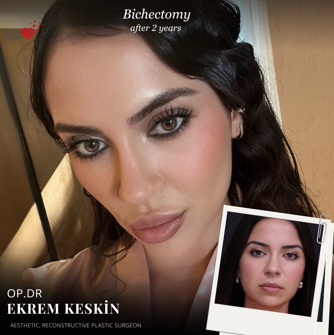 Burun Estetiği- Liposuction- Meme Estetiği-Karın germe -Op.Dr Ekrem KESKİN fotoğraf 7